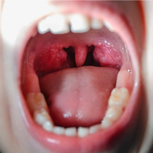 Laryngitis Treatment In Mumbai 5 Adenoid and Tonsil