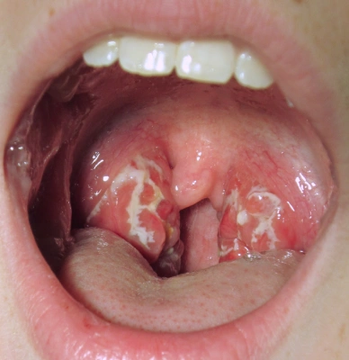 Tonsillitis Treatment in Mumbai 1 Tonsillitis Treatment in Mumbai