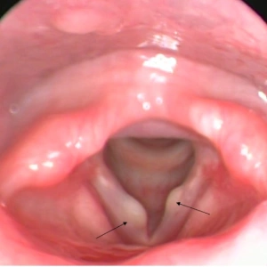 Laryngitis Treatment In Mumbai 2 Vocal fold cyst