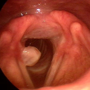 Laryngitis Treatment In Mumbai 4 Vocal fold granuloma