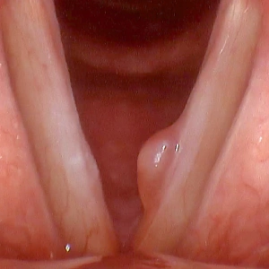 Laryngitis Treatment In Mumbai 3 Vocal fold polyp