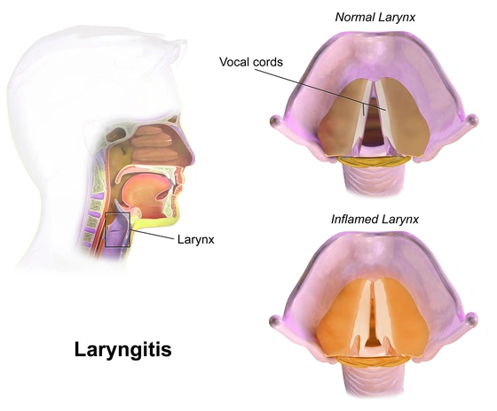 Laryngitis Treatment In Mumbai 1 laryngitis Treatment