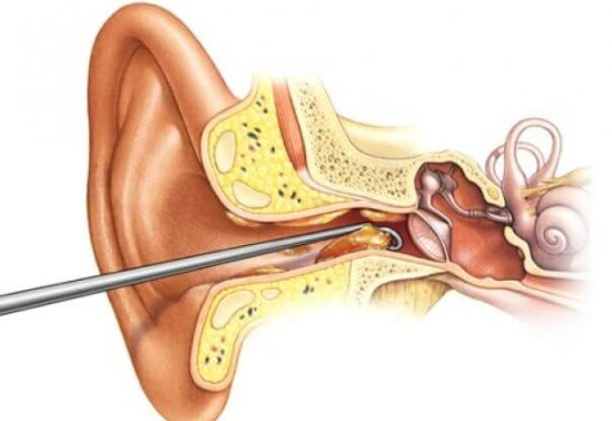 ENT doctor for wax removal in Mumbai 1 ENT Doctor for Wax Removal in Mumbai