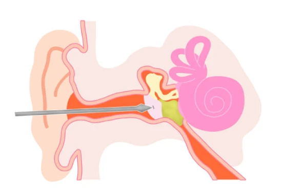 Best Myringotomy Doctor in Mumbai 1 Best Myringotomy Doctor in Mumbai