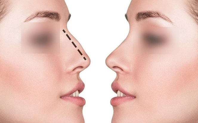 Septoplasty Surgery in Mumbai 1 Septoplasty Surgery in Mumbai
