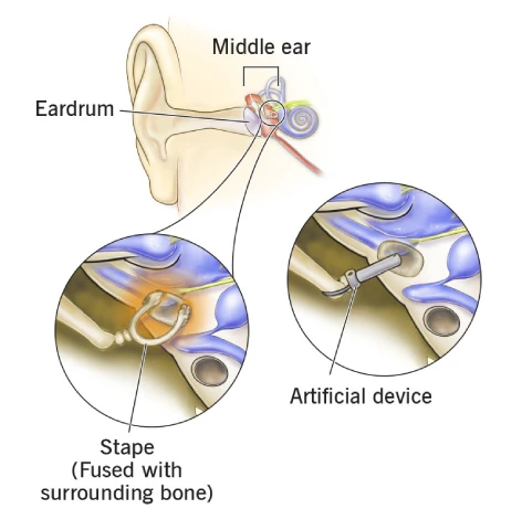 Stapedotomy Surgery in Mumbai 2 Stapedotomy