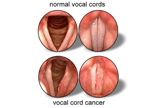 Vocal Cord Cancer Treatment in Mumbai 1 vocal cord cancer
