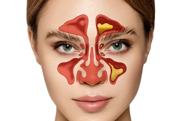 Chronic Sinusitis Treatment in Mumbai 1 chronic-sinusitis