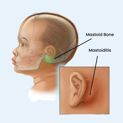 Mastoiditis