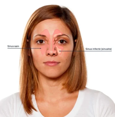 sinusitis Sinusitis